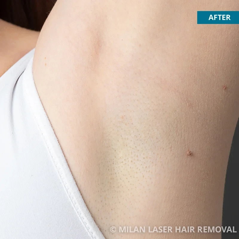 Before and after preview for underarm